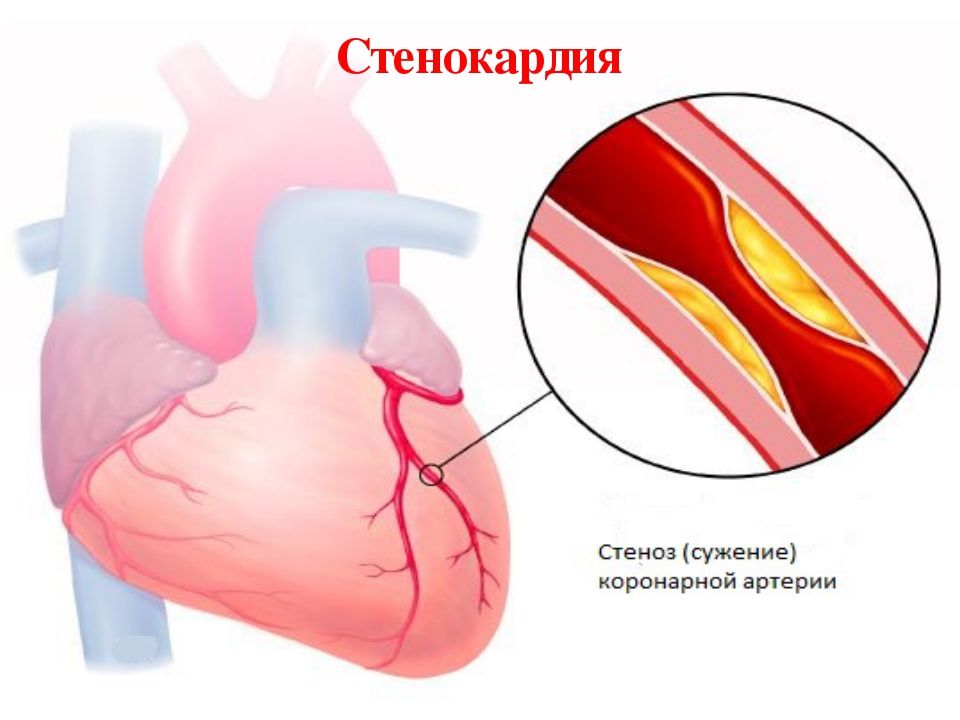 стенокардия сердца