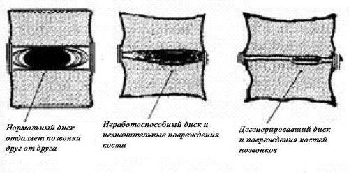 Классификация боли в поясничном отделе позвоночника