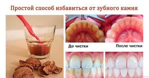 Как избавиться от зубного камня